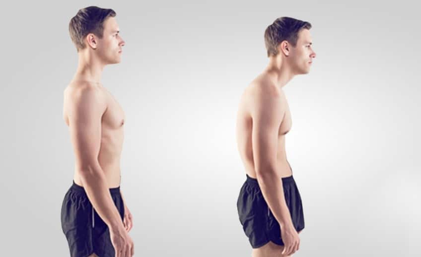 Diferencia Entre Cifosis Y Lordosis Causas Y Tratamiento