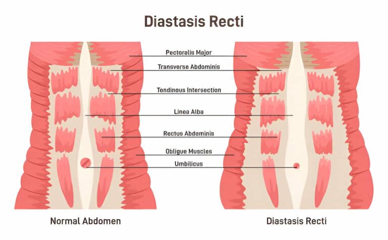 que es diastasis abdominal