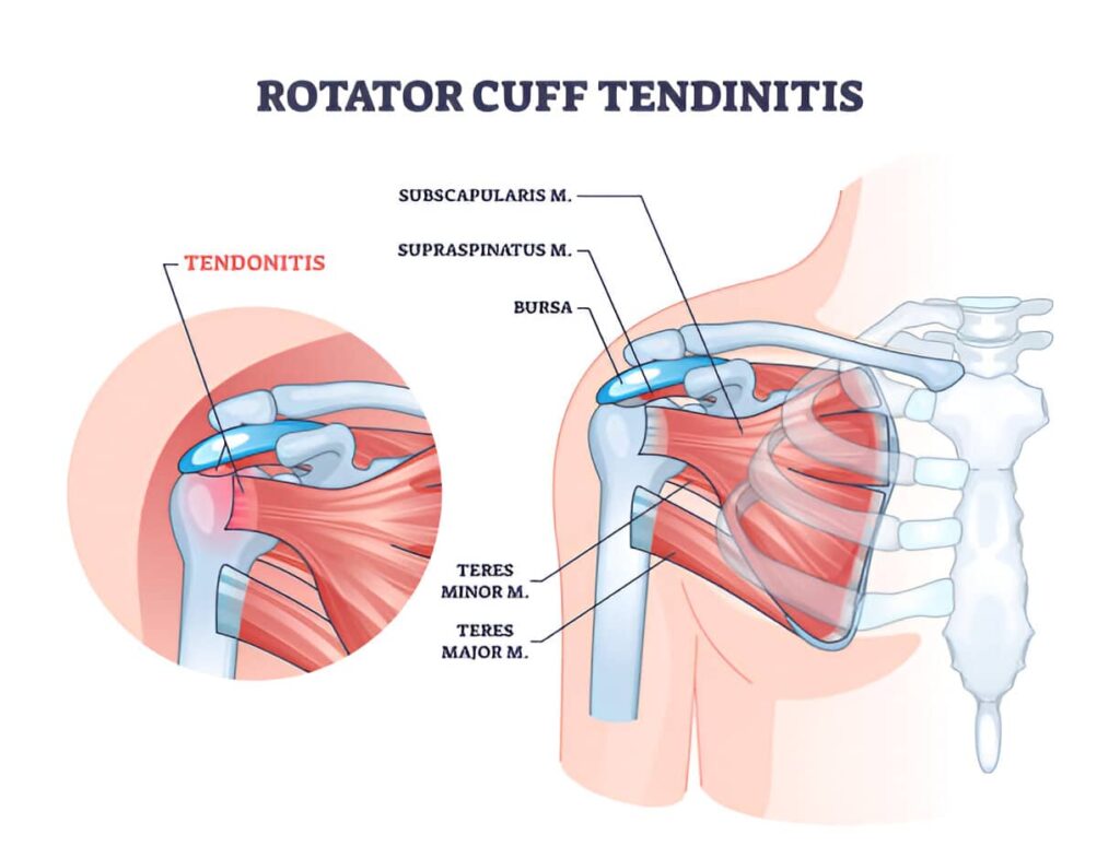 Tendinitis Del Supraespinoso Causas Síntomas Y Tratamiento