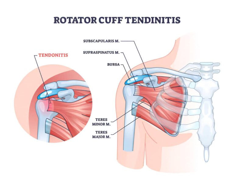 tendinitis del supraespinoso causas