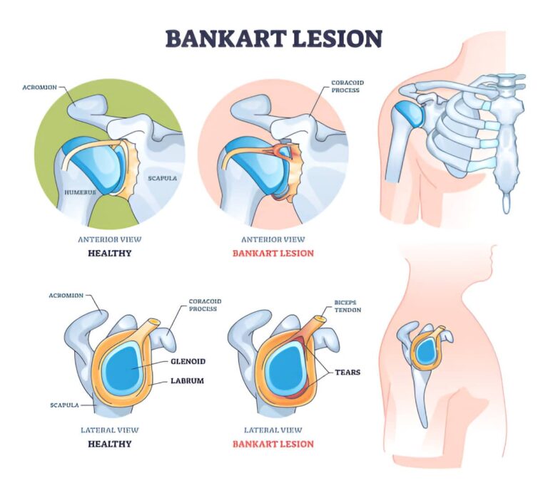 causas lesion de bankart