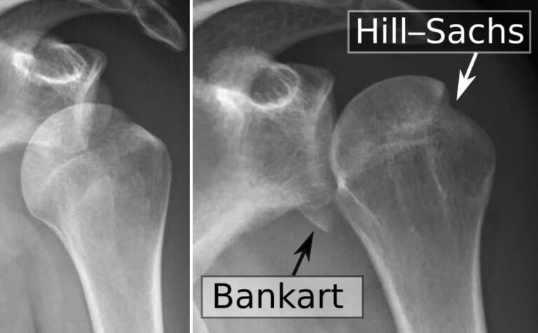 diferencia lesion de bankart y hill sachs