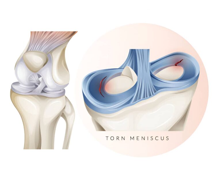 lesion menisco