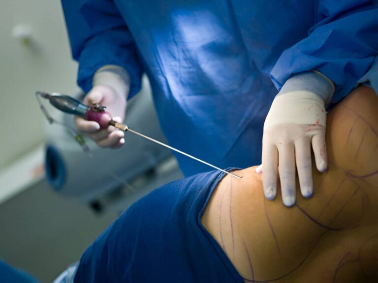 tratamiento celulitis