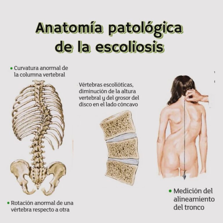 escoliosis en el embarazo